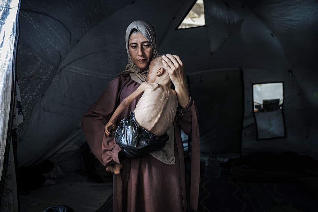 The image at the heart of the storm: Gazan 18-month old Muhammad al-Matouq suffering from medical issues and displaying signs of malnutrition (Ahmed Jihad Ibrahim Al-arini/Anadolu via Getty Images).